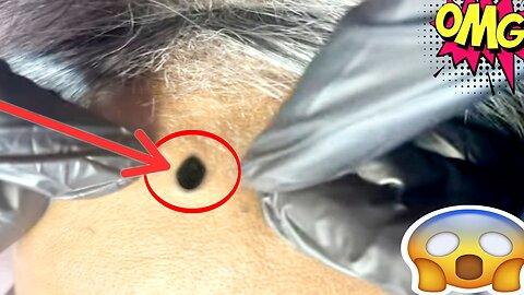 removal extration Blackhead