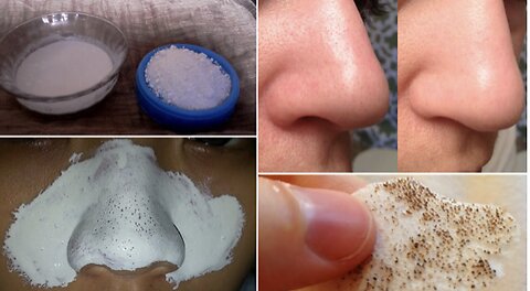 How to remove blackheads naturally