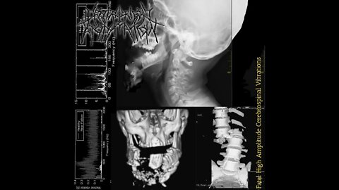 Centrifugal Atomization - Fatal High Amplitude Cerebrospinal Vibrations (Full EP)