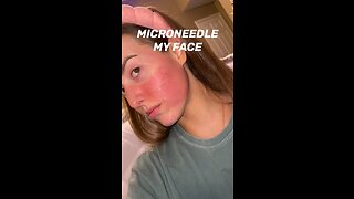 Microneedling my face