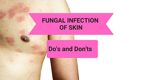 Fungal infection of skin | Do's and Don'ts | Dermatologist | Dr. Aanchal Panth