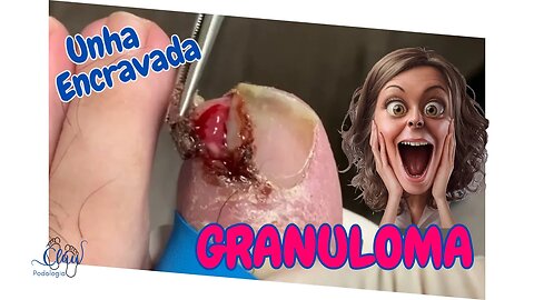 Granuloma devido a corte incorreto. UNHA ENCRAVADA! #podologia #unhas #pes #dor