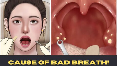 ASMR] Cause of bad breath! animation New