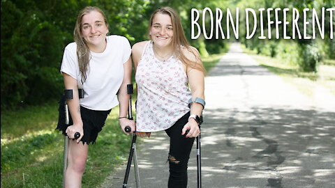 The Twins Who Used To Share One Body | BORN DIFFERENT