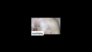 So Satisfying Blackheads removal!