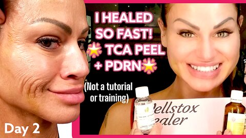 HOW I HEALED SUPER FAST From a TCA PEEL