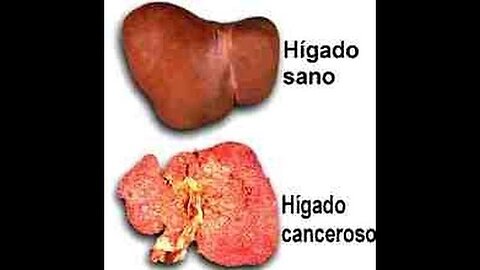 CÁNCER DE HÍGADO POR QUÉ SE PRODUCE