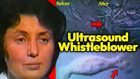 Ultrasound Whistleblower Dr Lebuskind Reveals Shocking Footage Of Aberrant Cells Post Ultrasound