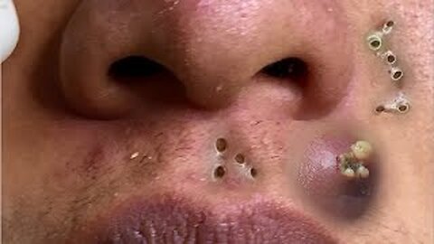 Relaxing, Satisfying blackheads removal and acne treatment on pimple popper 113