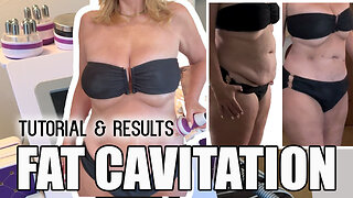 Fat Cavitation Tutorial & Results - Does it Work? Before & After