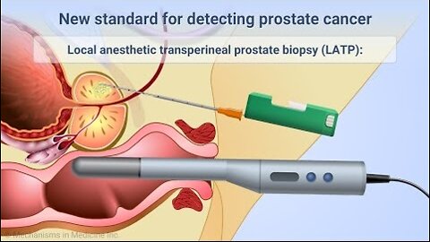 Transperineal Prostate Biopsies Under Local Anesthesia