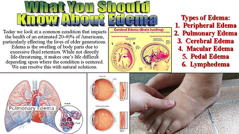 What You Should Know About Edema