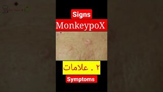 MonkeypoX. Signs and Symptoms #shorts #dr #monkeypox