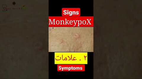 MonkeypoX. Signs and Symptoms #shorts #dr #monkeypox