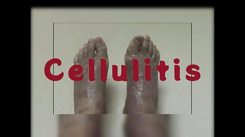 Unveiling Cellulitis: My Struggles, Treatments and Lessons Learned