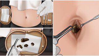 Removal Dirty and Huge Navel Stone ASMR - Cleaning in deep belly button - Smelly Stone Treatment