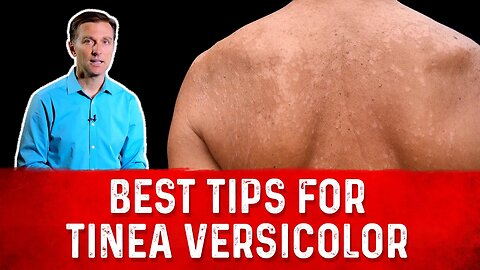 Best Tips for Tinea Versicolor Treatment (Skin Fungus) – Dr. Berg
