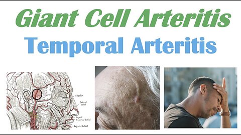 Giant Cell Arteritis (Temporal Arteritis) | Causes, Pathophysiology, Symptoms, Diagnosis, Treatment