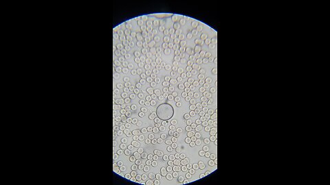 Rouleaux Formation Corrected With Aspirin