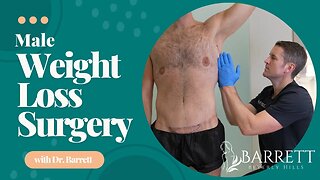Male Weight Loss Surgery - Mid Thoracic Lift, Extended Medial Thigh Lift, & Suprapubic Lift