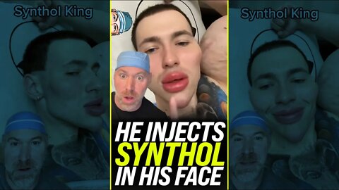 Injecting Synthol Into Your Face?! 😱 #shorts