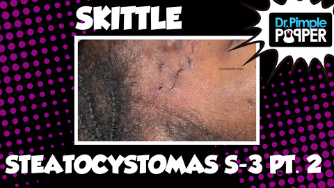 Skittle Steatocystoma, Session Three Part 2