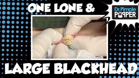 Dr Pimple Popper: One Lone & Large Blackhead