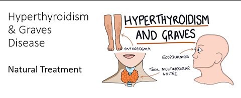 Hyperthyroidism & Graves disease Natural treatment