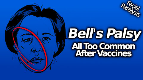 STAGGERING: 2,500+ VAERS Reports Of Bell's Palsy/ Facial Paralysis After Controversial "Vaccines"