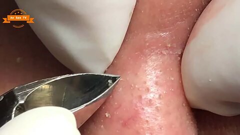 blackheads removal 3