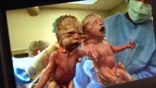 Rare 'mono mono' identical twins born holding hands turning 7 years old on Mother's Day