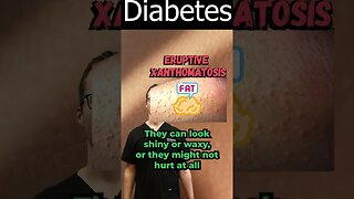Eruptive Xanthomatosis Pictures & Treatment [Diabetes & Diagnosis]