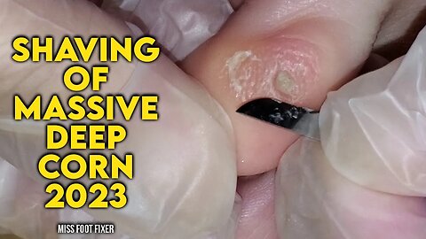 SHAVING OF MASSIVE DEEP SEEDED CORN REMOVAL 2023 BY FOOT DOCTOR MISS FOOT FIXER