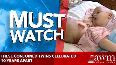 These Conjoined Twins Celebrated 10 Years Apart