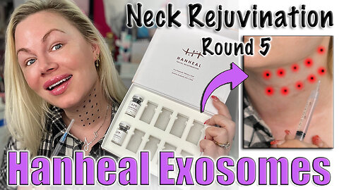Neck Rejuvenation with Hanheal Exosomes: Round 5, AceCosm | Code Jessica10 saves YOU Money