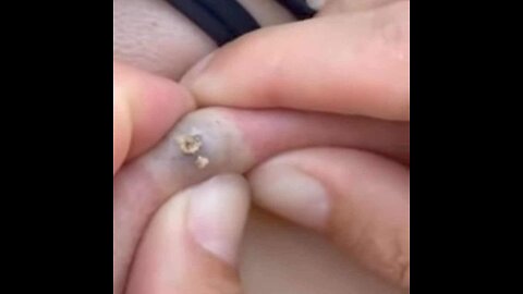 Pimple popping and blackhead