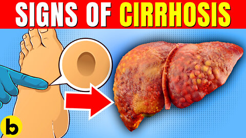 8 Warning Signs Of Cirrhosis You Need To Know