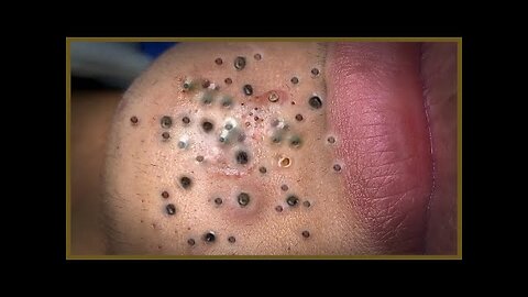 Satisfying blackhead removal, relaxing Pimple Popper