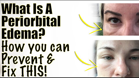 What is a PERIORBITAL Edema? How you can PREVENT and Fix This! Code Jessica10 Saves you Money