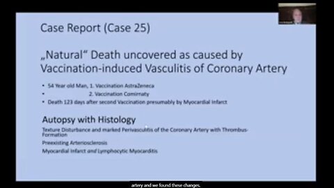 Vax Autopsy Part 2 - Lipid Nanoparticles in SPLEEN