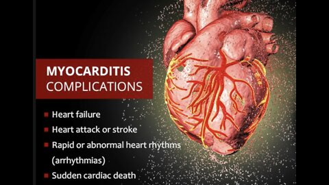 COVID 19 Vaccine, Children and the risk of Myocarditis.