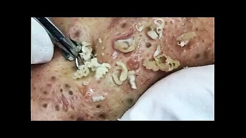 PimplePopper Blackheads Whiteheads Removal