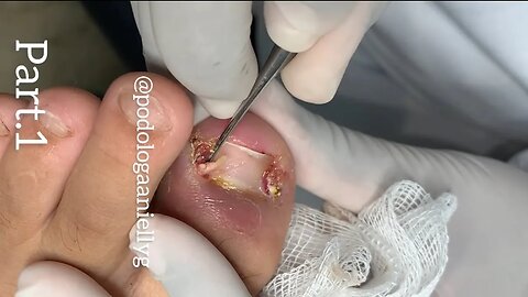 Diga adeus à unha encravada com esse simples procedimento #podologia #ingrown_toenail #unhaencravada