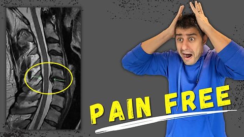 Chronic Neck pain recovery without surgery