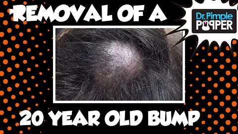 A 20-year old Embarrassing Bump on the Scalp: Dr Pimple Popper