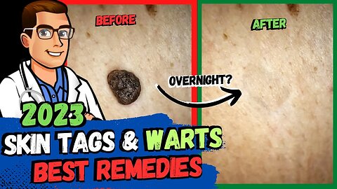 Skin Tags & Plantar Warts DISAPPEAR Overnight? [Best Home Remedies]