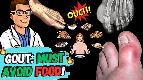 🔥Best Gout Diet & Foods To Avoid🔥 [URIC ACID Foods that Cause Gout!]