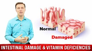 Intestinal Obstruction & Vitamin Deficiencies – Dr. Berg