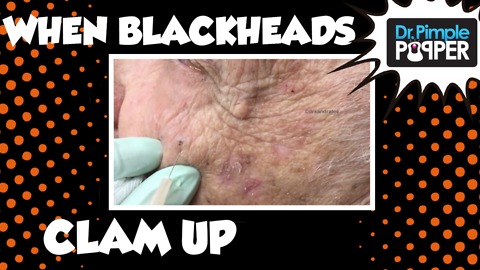 When Blackheads Clam Up