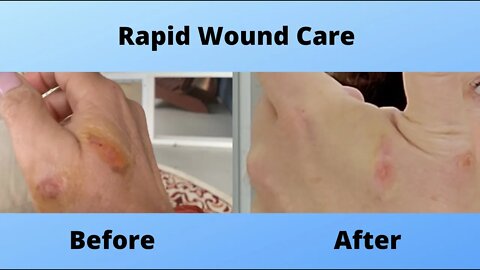 Have you ever had a wound that wouldn't heal?
